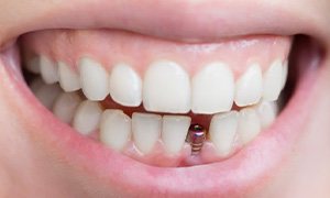 Smile with dental implant