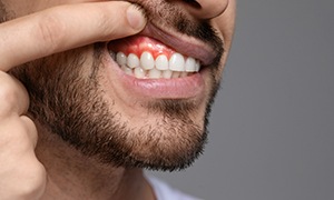 Man showing his red and inflamed gum tissue