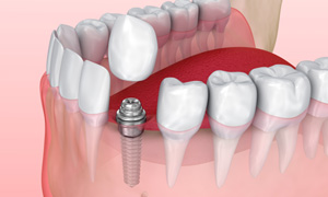 Illustration of a single dental implant