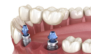 Illustration of an implant bridge