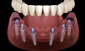 Illustration of an implant denture