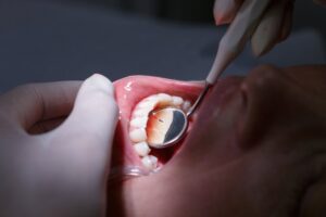 Closeup of patient being examined for gum disease in Metairie