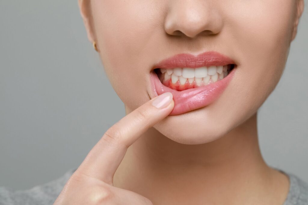 Nose-to-neck view of woman pulling her lower lip down to reveal red swollen gums